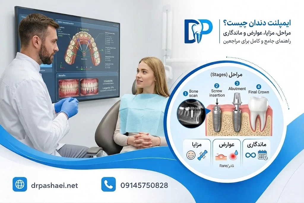 ایمپلنت دندان چیست؟ مراحل، مزایا، عوارض و ماندگاری